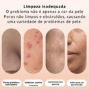 Aparelho Removedor De Cravos E Espinhas À Vácuo Com 3 pontas Remoção Eletrônica de Cravos - BrazilStory