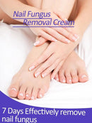 Creme da remoção de fungo, Tratamento do pé, Anti-infecção, Anti-Fungal, Onychomycosis, Paronychia - BrazilStory